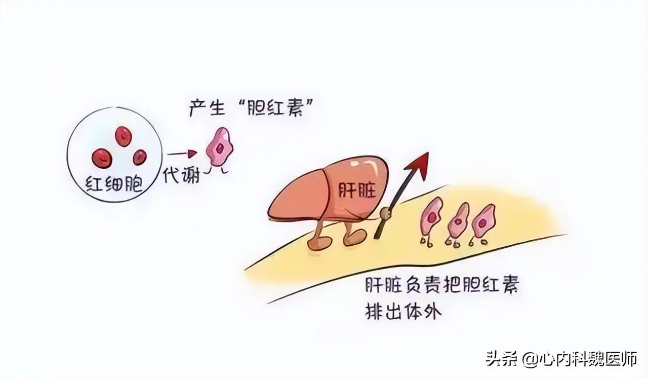 ，随后胆汁淤积，胆红素排出障碍引起血清内胆红素升高，最终出现黄疸。