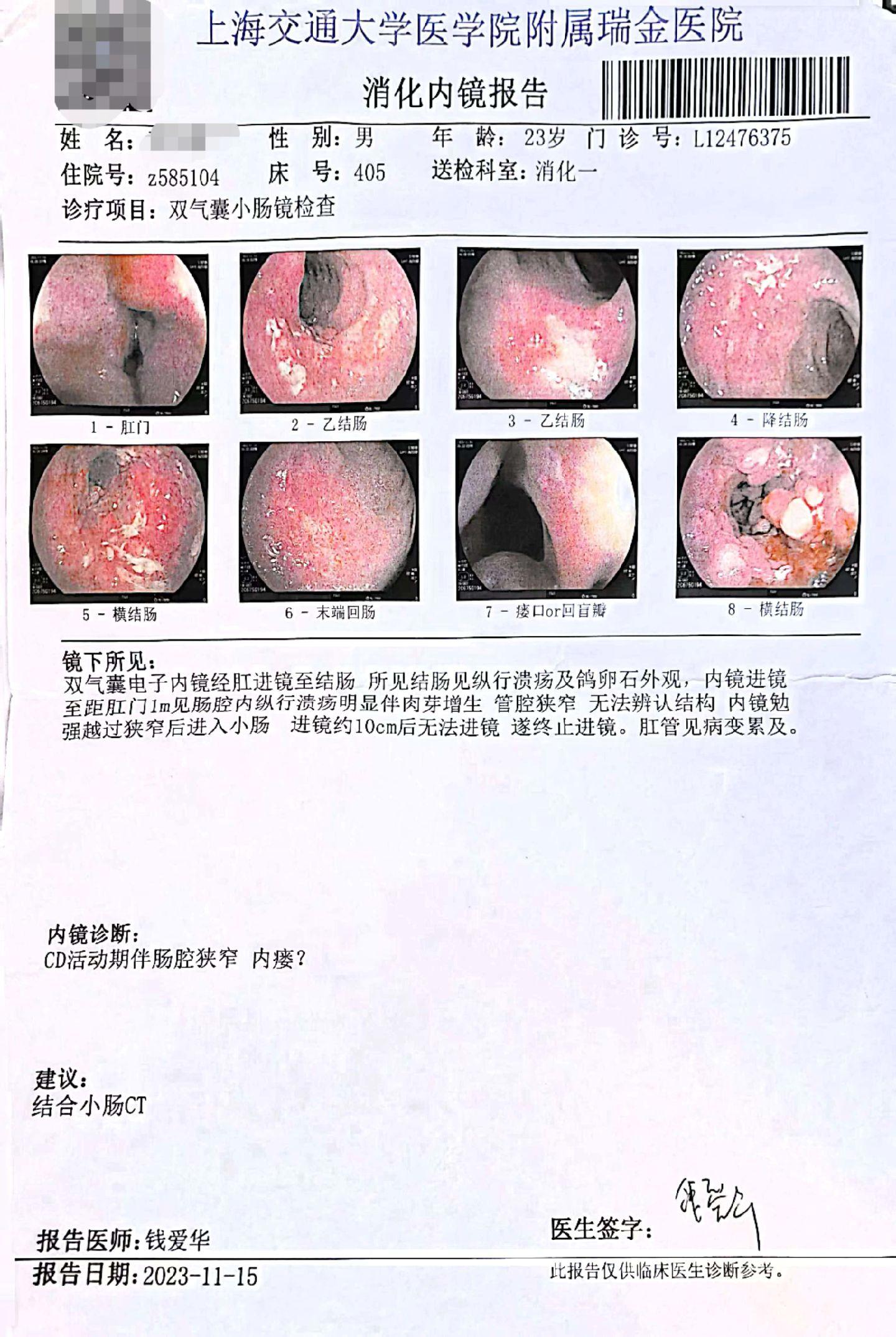 挽救8年克罗恩病小伙子的肠道。 8年病程的小伙子，去年肠镜中重度，一直...