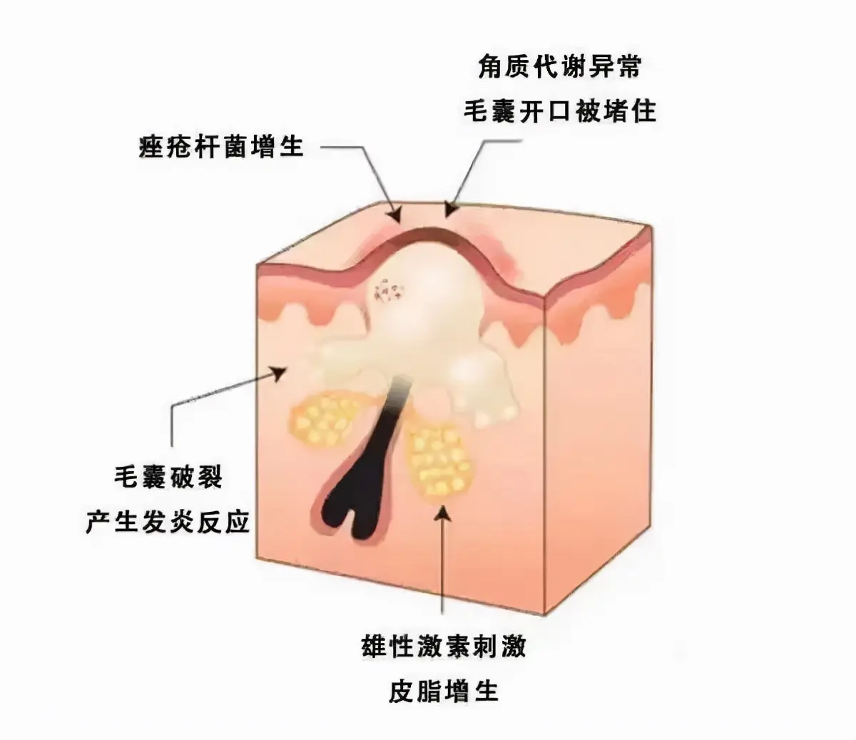 再接着说冒痘，痘痘和出油也是紧密相连的，皮脂腺过度分泌油脂或者角质