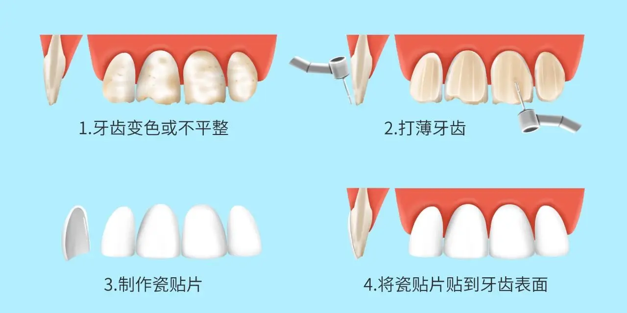 的强度，也能保证与牙齿表面粘接非常牢固，对于中重度变色牙效果很好。