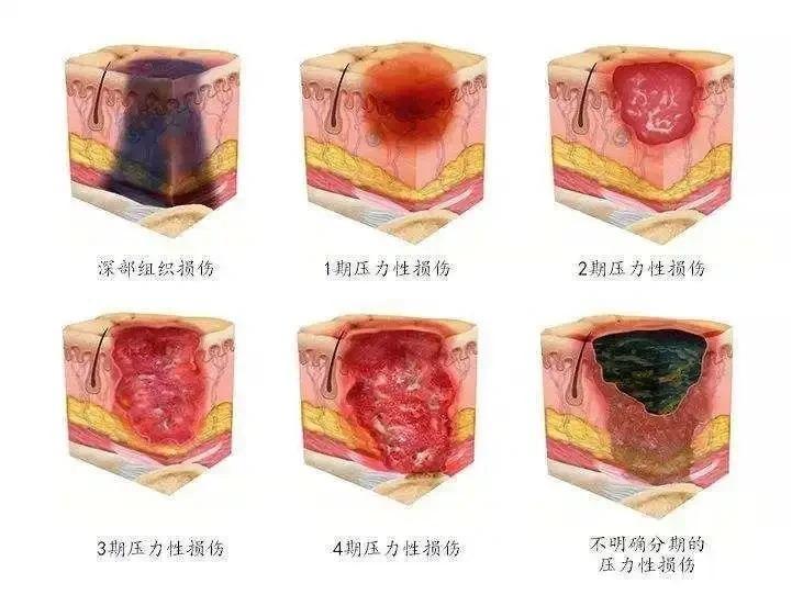 逆袭必备！压疮分期知识大公开