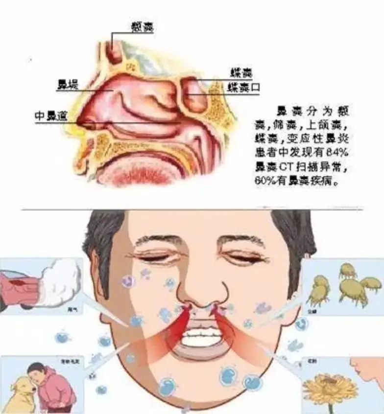 过敏性鼻炎会影响什么
