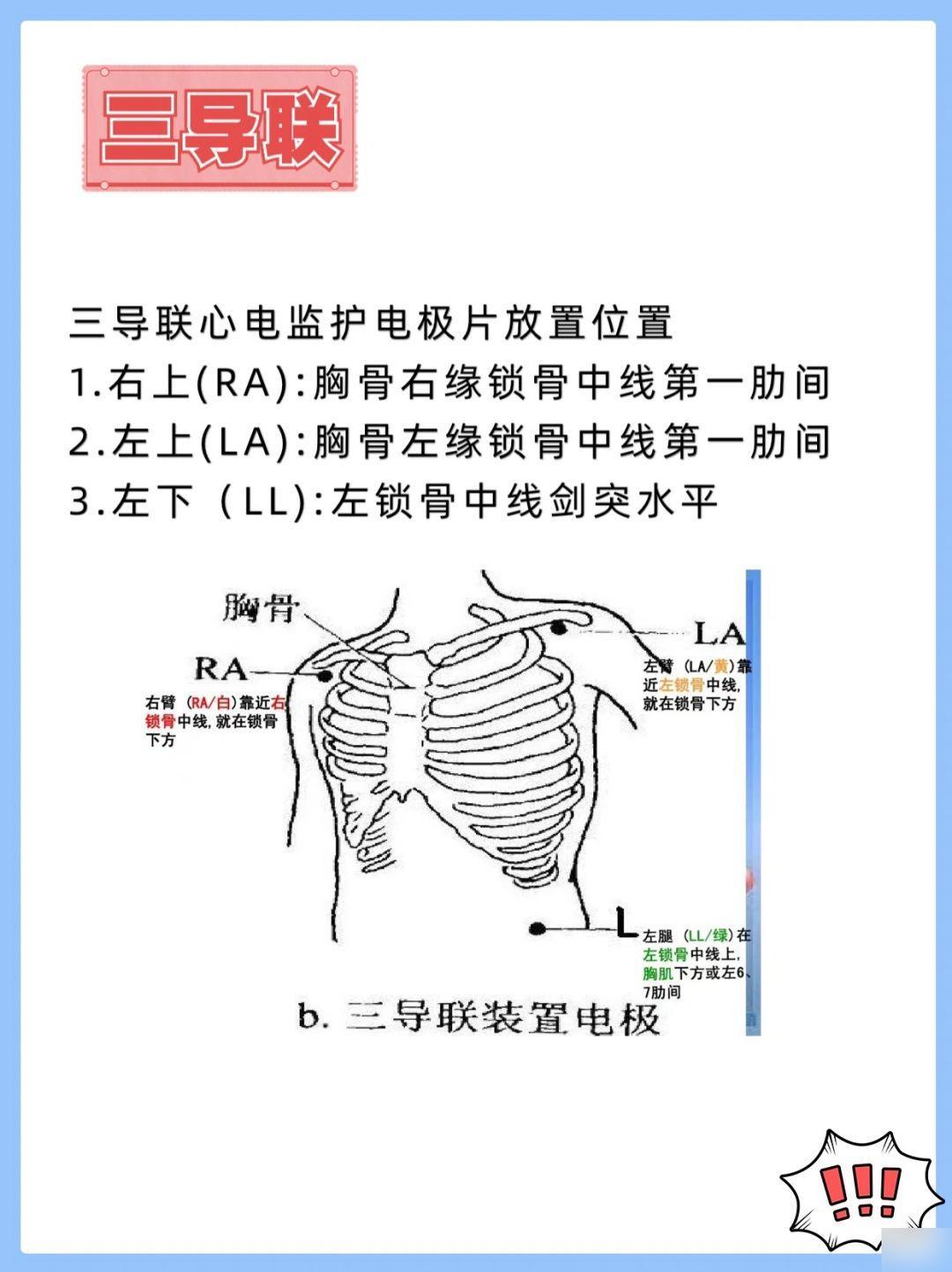 实习护士必备，心电监护导联安置技巧