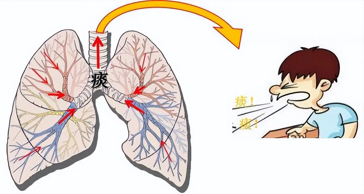 出现10个症状，可能是支气管扩张！这8类人要注意！做好日常预防