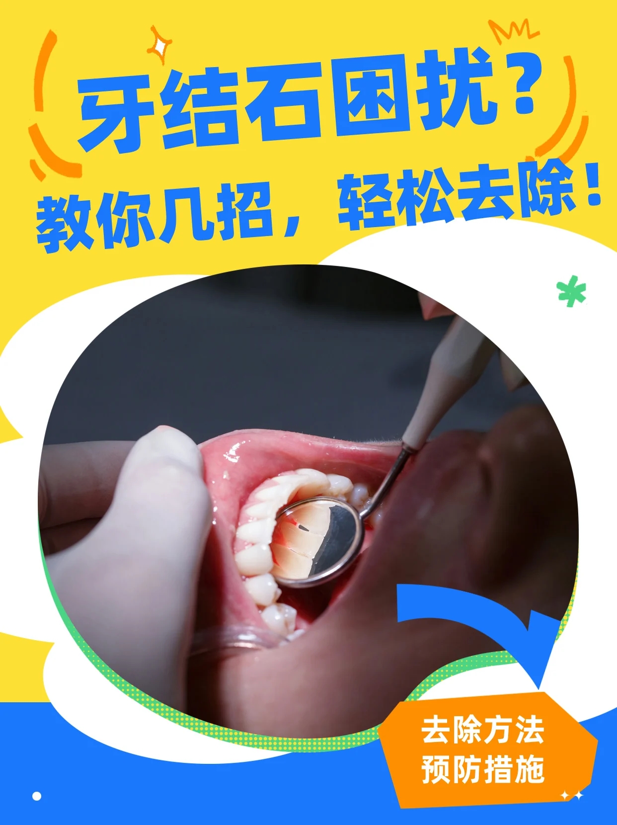 牙结石困扰？教你几招，轻松去除