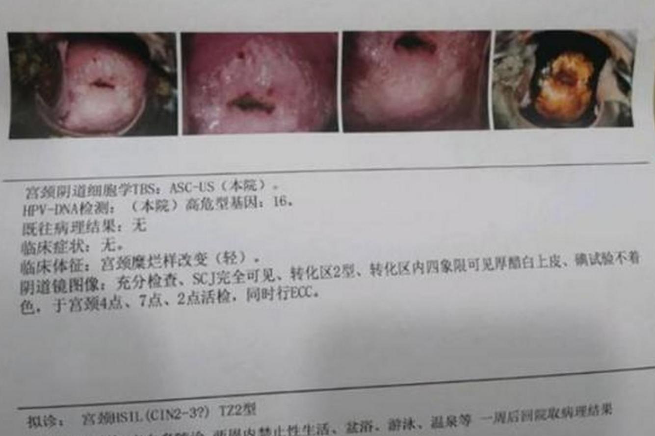 身上有hpv病毒患者看过来，我只发一次。 昨天接诊了一位45岁的hpv...
