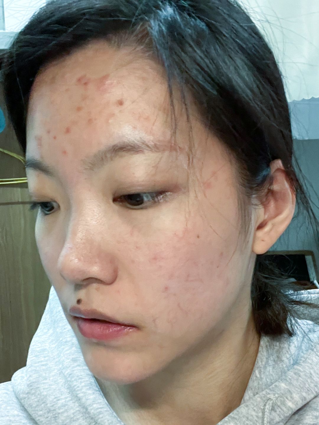 重获自信！我的痘痘脸终于有救了！