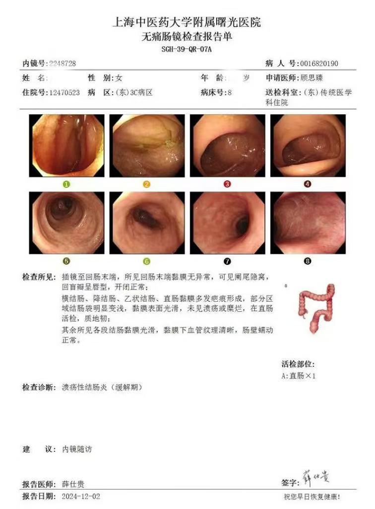 让中重度溃疡性结肠炎孕妇转危为安。 山东的患者，溃结病情控制不佳，既往...
