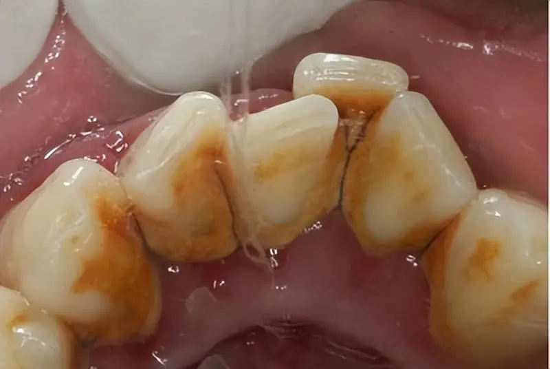 牙结石困扰终于摆脱！我的去石秘诀一定要看，学会牙齿焕然一新！