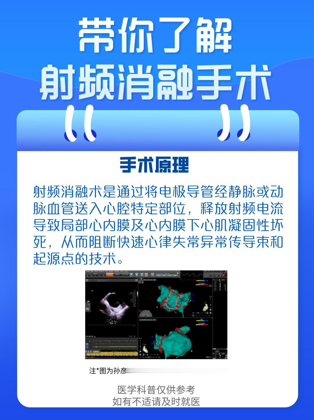 带你了解射频消融手术。
