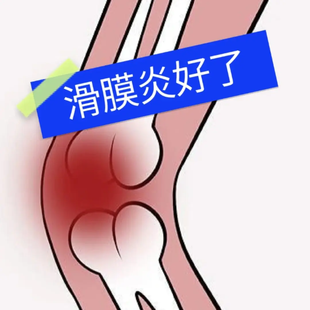 过来人教你快速缓解滑膜炎！80%的滑膜积液，都是这样消除的！