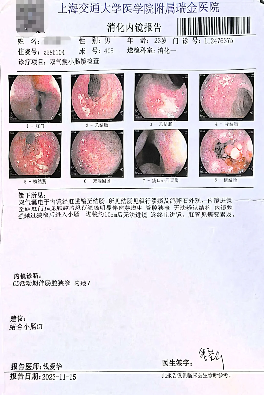 挽救8年克罗恩病小伙子的肠道。