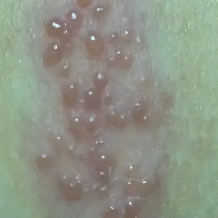 皮疱疹、疼痛、红肿、瘙痒等，还会出现同一部位的头痛，可累及眼结膜。带状疱疹 图源陕西省皮防所患者会先