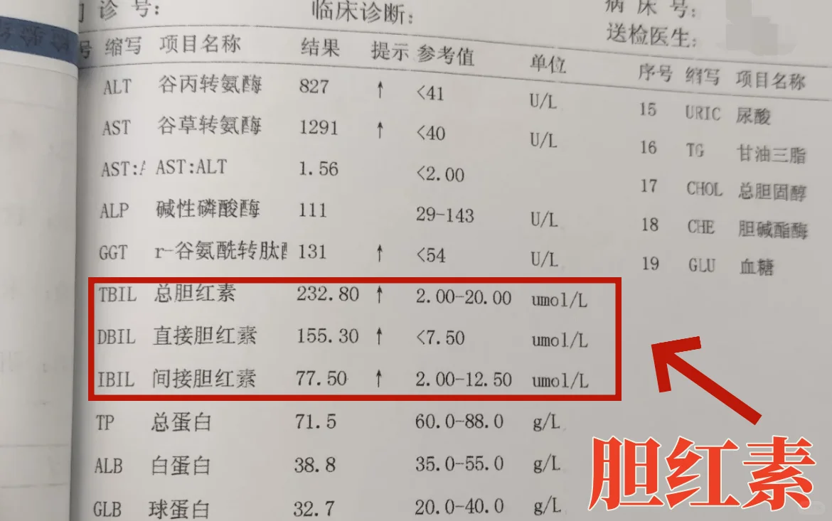 肝功能解读之——胆红素